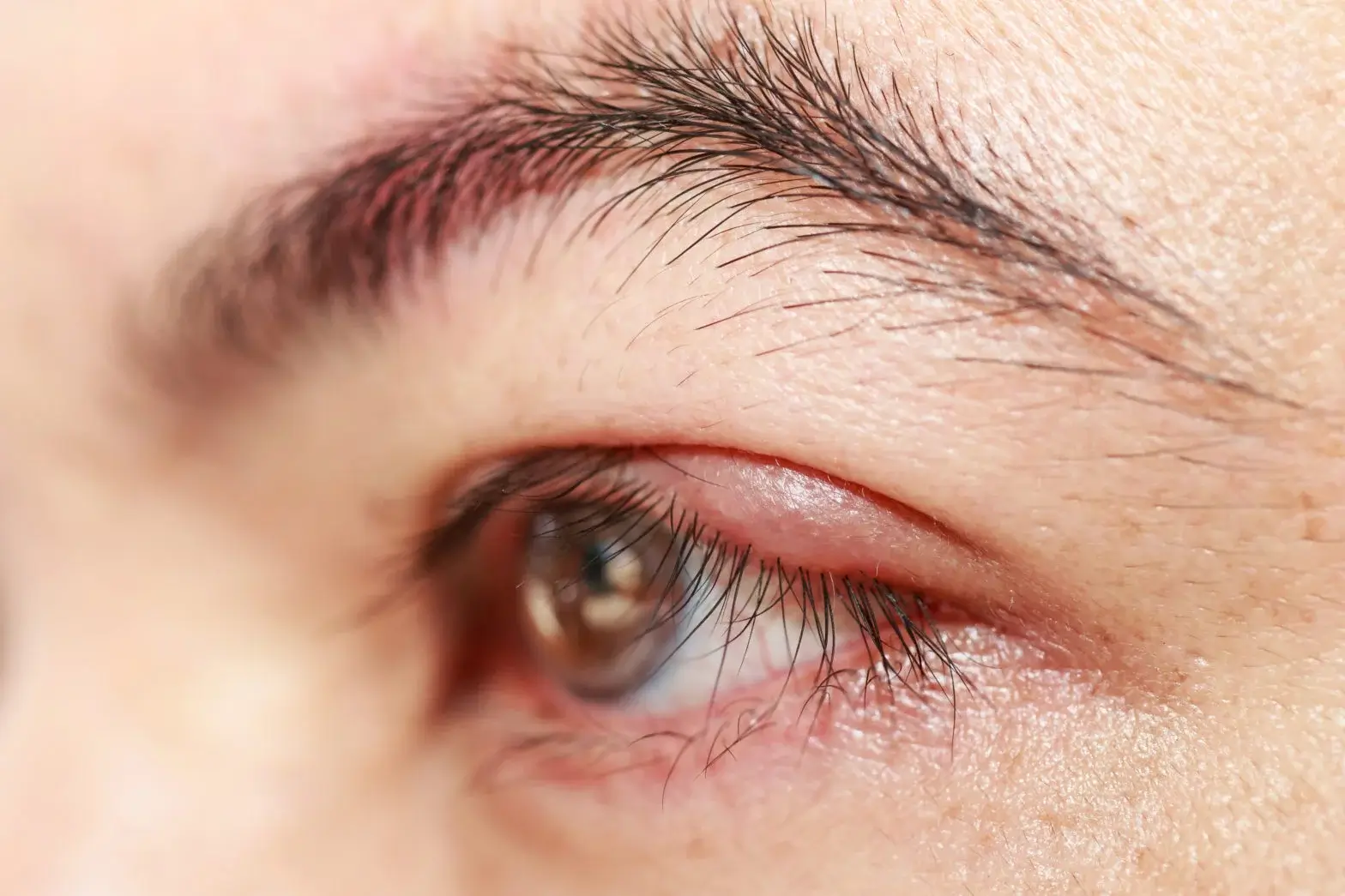Understanding and Treating Blepharitis: An In-Depth Guide to Anterior Blepharitis and Posterior Blepharitis