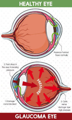 Understanding Narrow-Angle Glaucoma