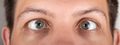Treatment Options for Exotropia: From Glasses to Surgery