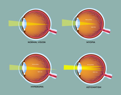 Cylindrical Power or astigmatism
