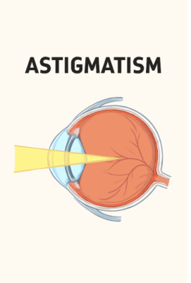 Astigmatism vs Myopia